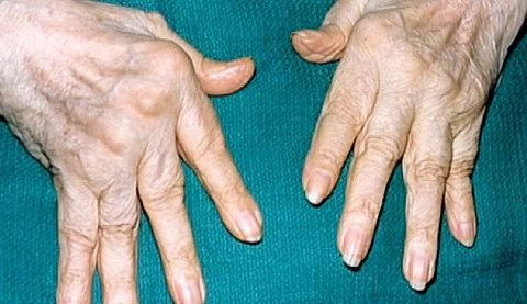 Smerter i leddene av fingrene