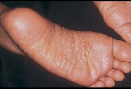 Dermatitt av ben og dens årsaker