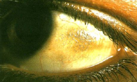 Xerophthalmia.  Bitos plaketter ser forhøyede, med avsetning av flere skalaer, konjunktivssider lokalisert i en sone som ikke dekkes av øyelokkene.  Som i dette tilfellet blir patologiske områder ofte pigmentert.