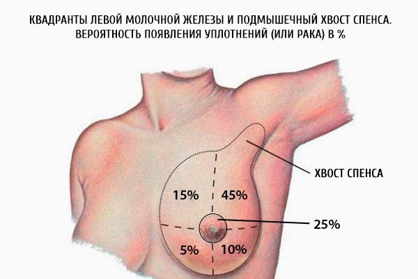 Kvadranterne til venstre bryst og spindelens aksillary spence.  Sannsynligheten for sel (eller kreft) i%
