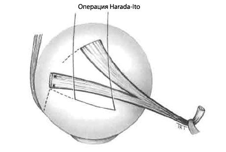 Strabismus - Operasjon