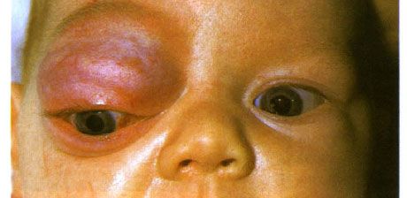 Kapillær hemangiom i den fremre delen av bane og øvre øyelokk.  Neoplasm har en tendens til å utvikle seg