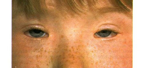 Syndrom av blepharophimosis.  Tosidig betjent ptosis, telecanthus og blepharophimosis