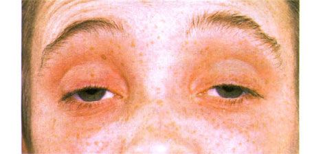 Ekstern oftalmoplegi.  Tosidig ptosis.  Pasienten åpner øynene ved å heve øyenbrynene
