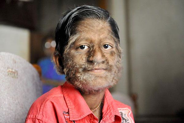 Varulvs syndrom