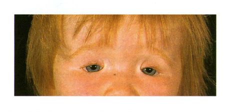 Tosidig kolobom i øyelokkene i et barn med Goldens syndrom.  Lukking av øyeslitsen til venstre