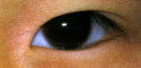 Epiblefaron.  Feil vekst av øyenvipper feires fra fødselen.  Noen ganger er det en spontan forbedring